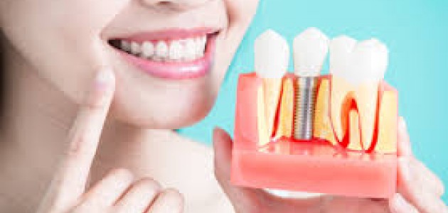 Dis Implant Fiyatlari Saglik Haberleri