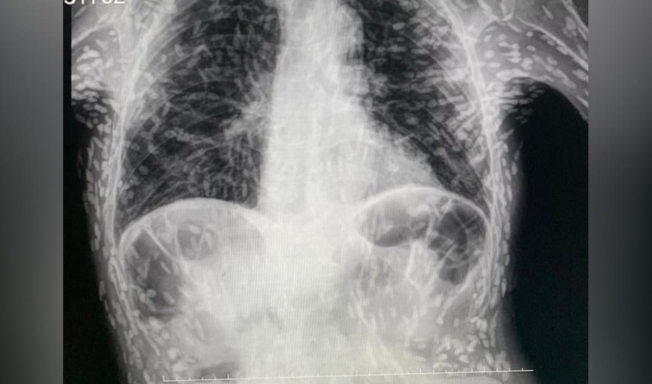Öksürük şikayetiyle gitmişti! Midesinden çıkanlar doktorları şok etti