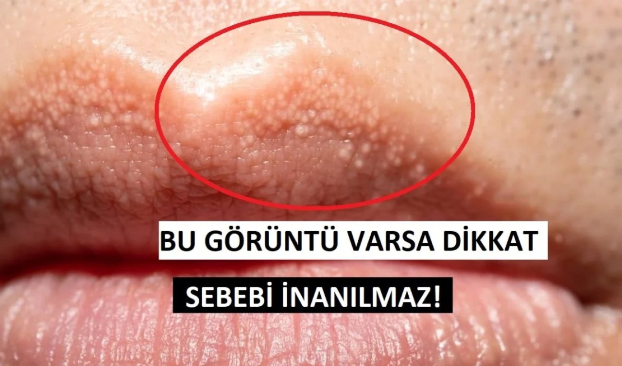 Dudaktaki minik beyaz noktaların gizemi çözüldü!