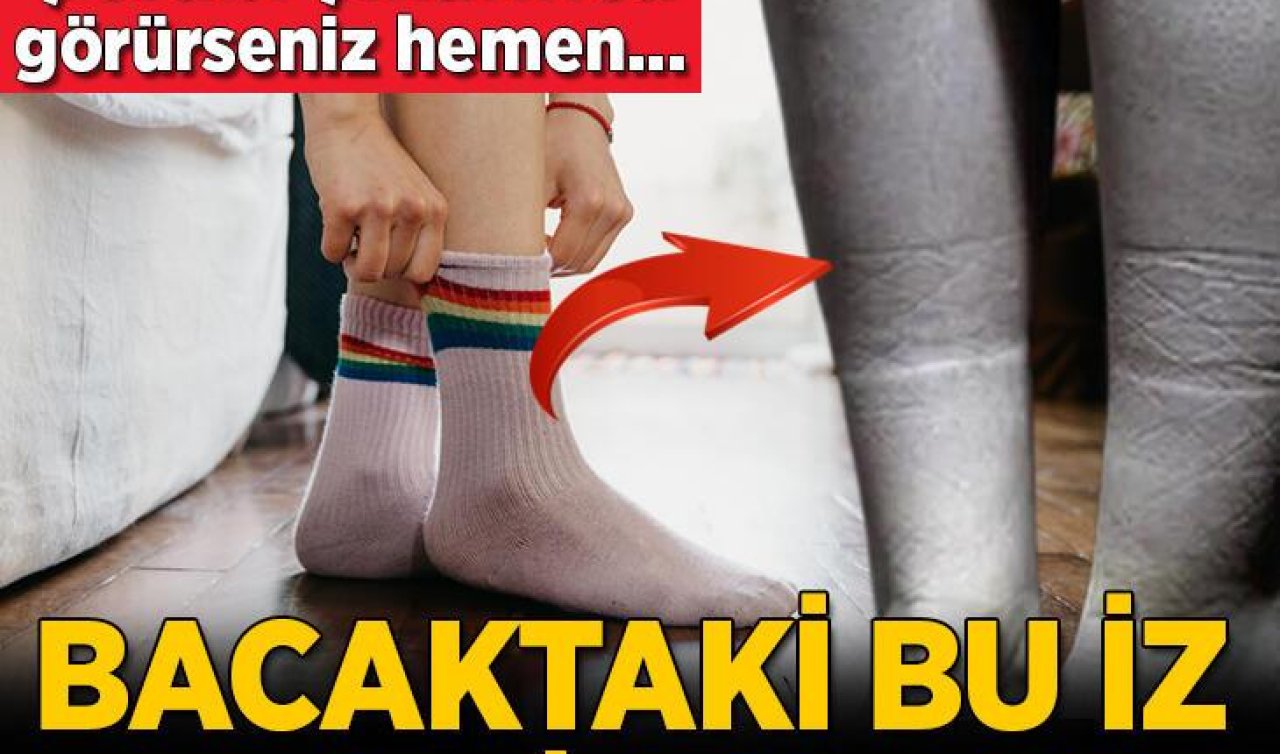 Çorap Giydiğinizde İz Çıkıyorsa... Bu Bir Hastalık İşareti Olabilir!