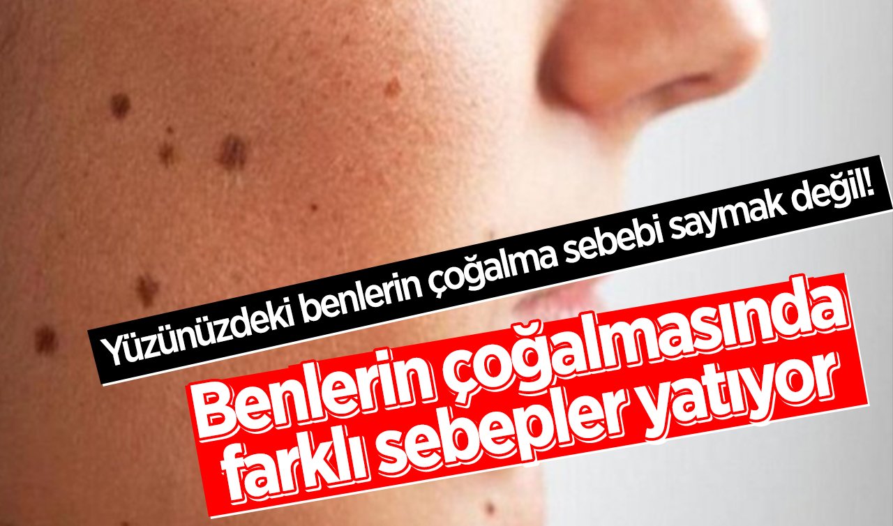  Yüzünüzdeki benlerin çoğalma sebebi saymak değil! Benlerin çoğalmasında farklı sebepler yatıyor 