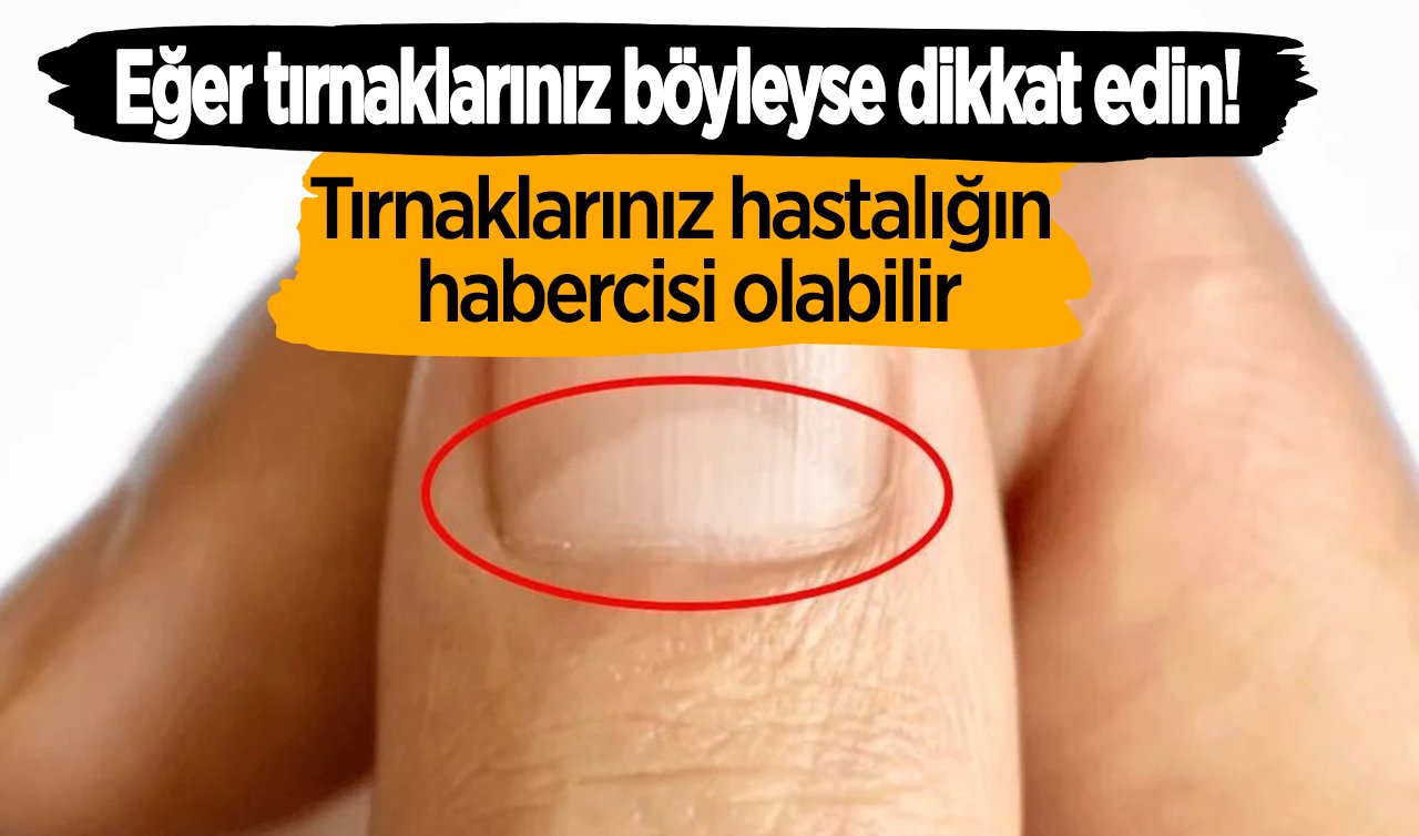 Eğer tırnaklarınız böyleyse dikkat edin! Tırnaklarınız hastalığın habercisi olabilir