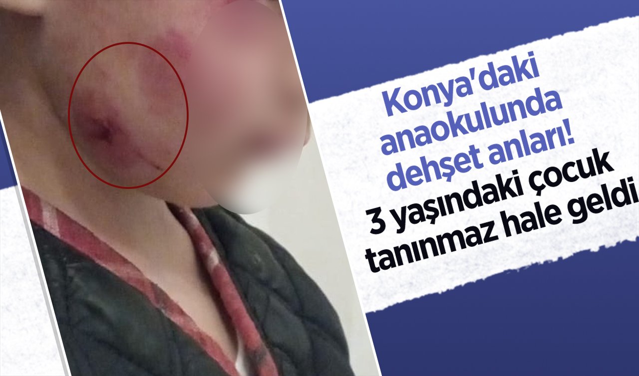  Konya’daki anaokulunda dehşet anları! 3 yaşındaki çocuk tanınmaz hale geldi