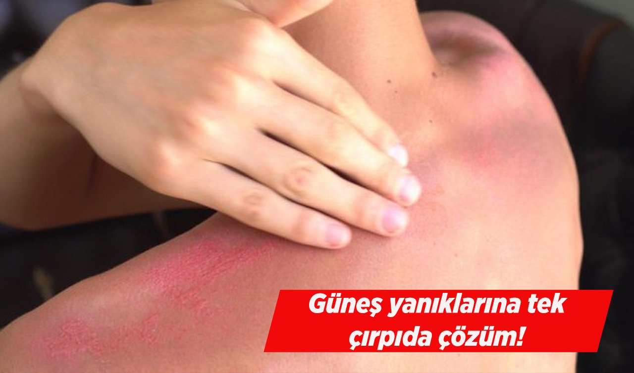  Güneş yanıklarına tek çırpıda çözüm! Siyah çayı bu şekilde kullanarak... 
