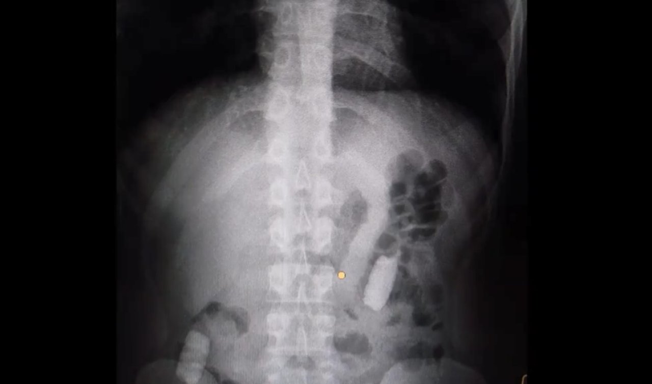Midesinde taşıdığı 1 kilo uyuşturucuyla yakalandı