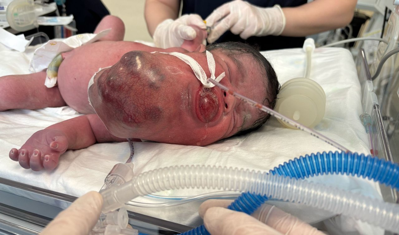 34 haftalık doğan Eymen bebeğin boynundan 445 gram tümör çıkarıldı