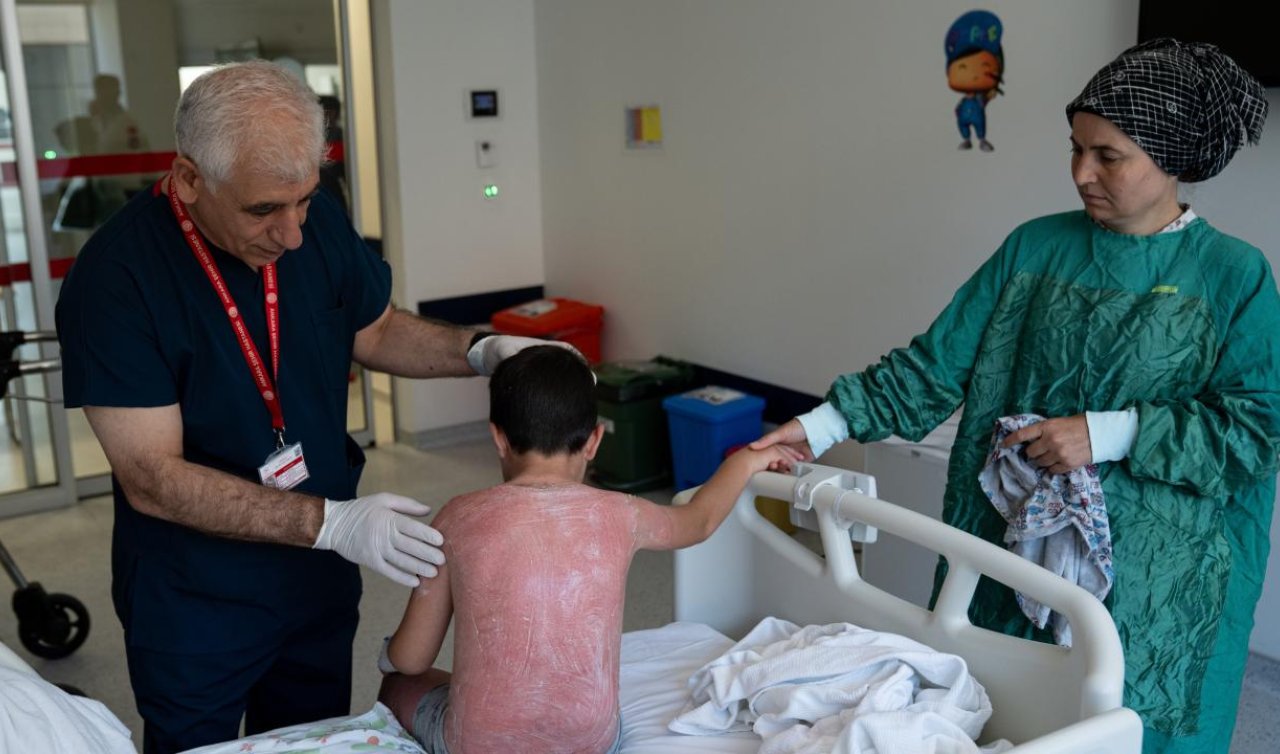 Güneşte 4 saat kalan çocuk ikinci derece yanık oldu