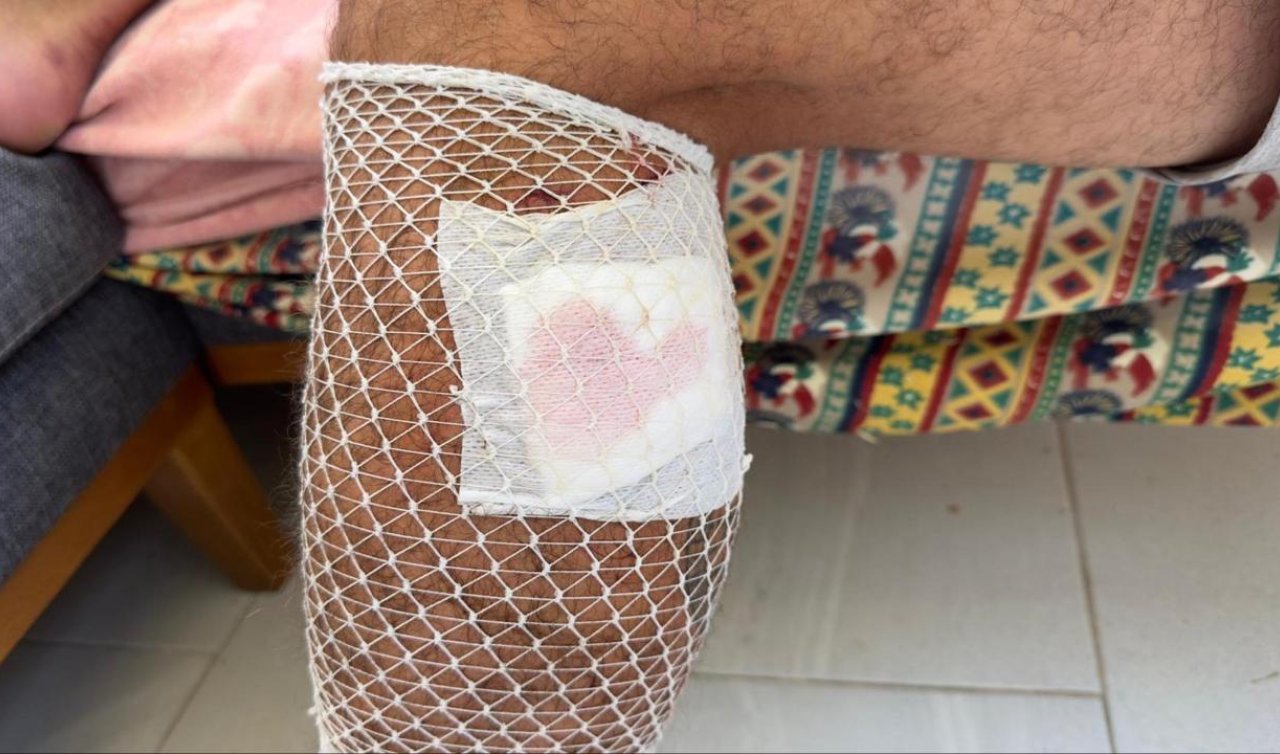 Yürüyüş yaparken başıboş sokak köpeklerinin saldırısına uğradı