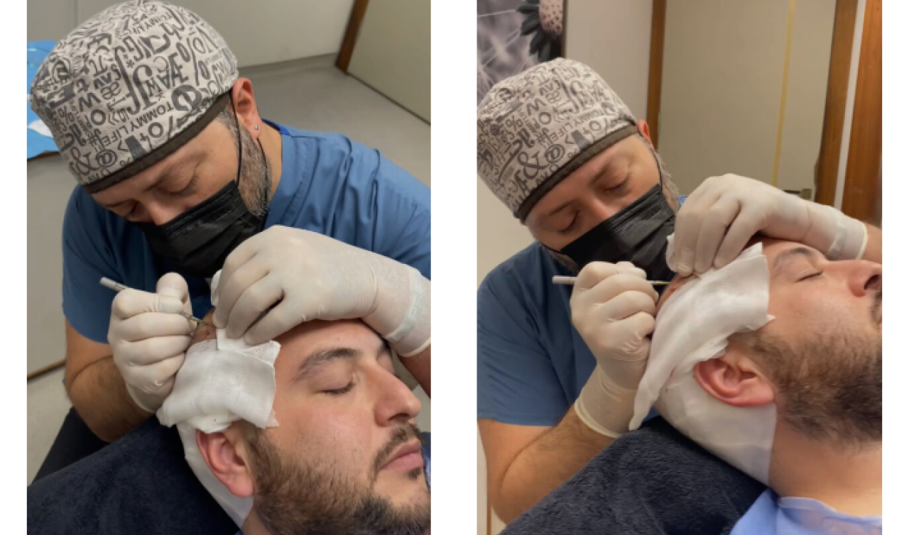  SDHI Hair Transplant