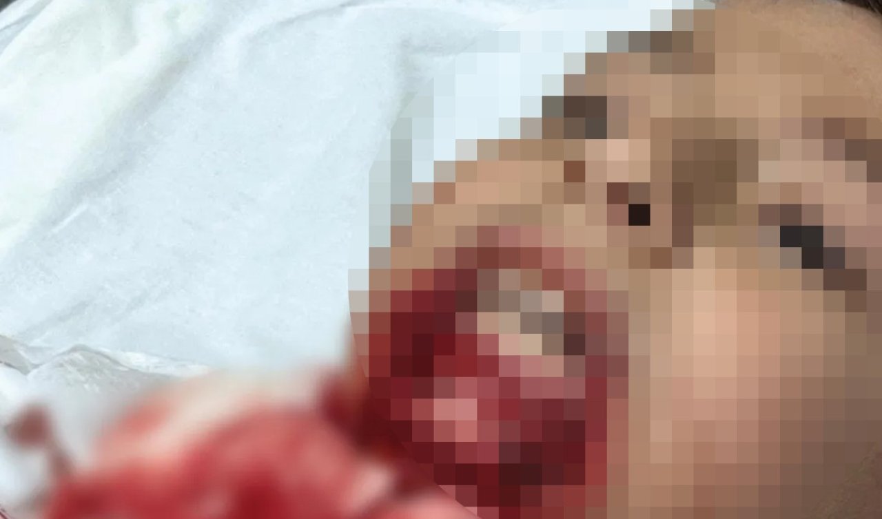 İlkokul öğrencisinin çenesi saplanan demir yüzünden koptu! 
