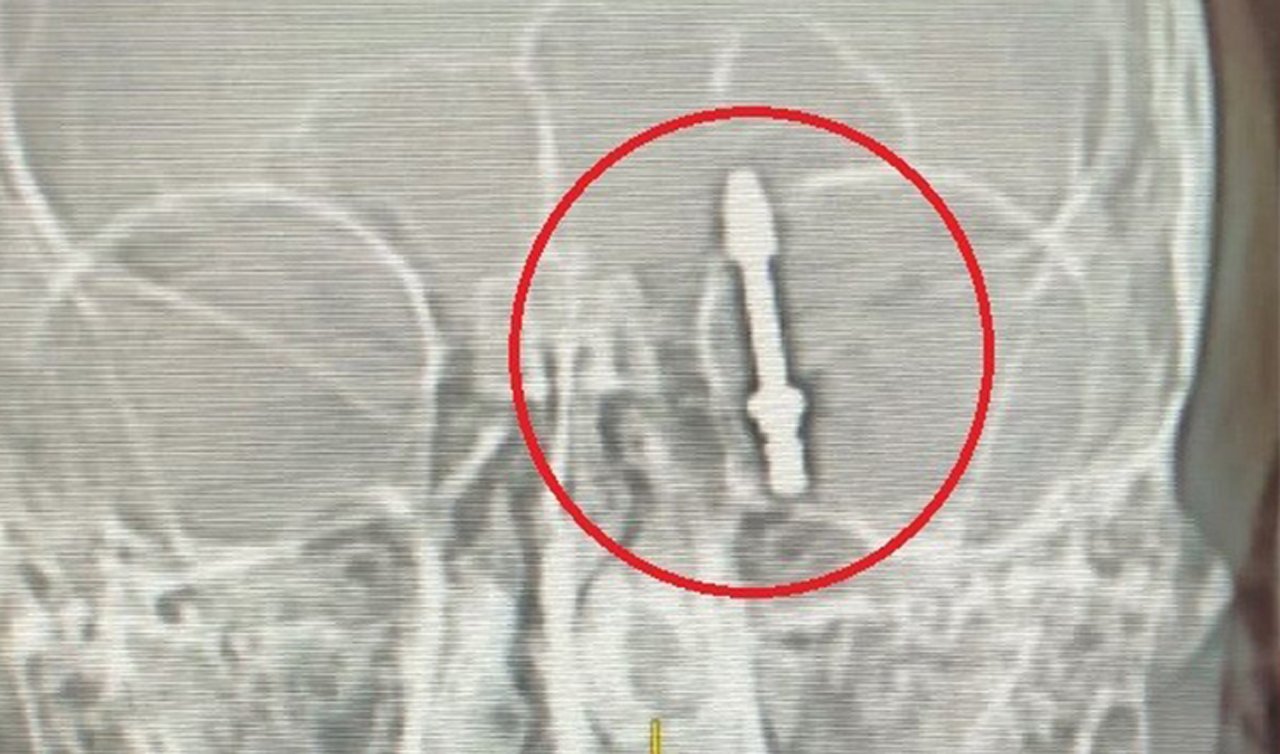 Diş tedavisi için gitti! Beynine saplanan implant hayatını kararttı!