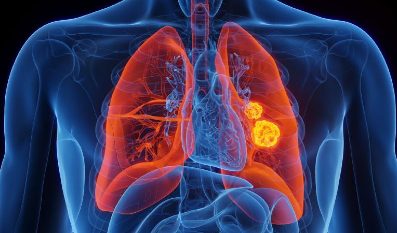 Önlem alınmazsa kanser kaynaklı ölümler 2050’ye kadar iki katına çıkacak