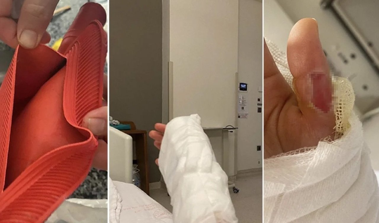 Sıcak su torbası patladı: Genç kızın vücudunun yüzde 25’i yandı