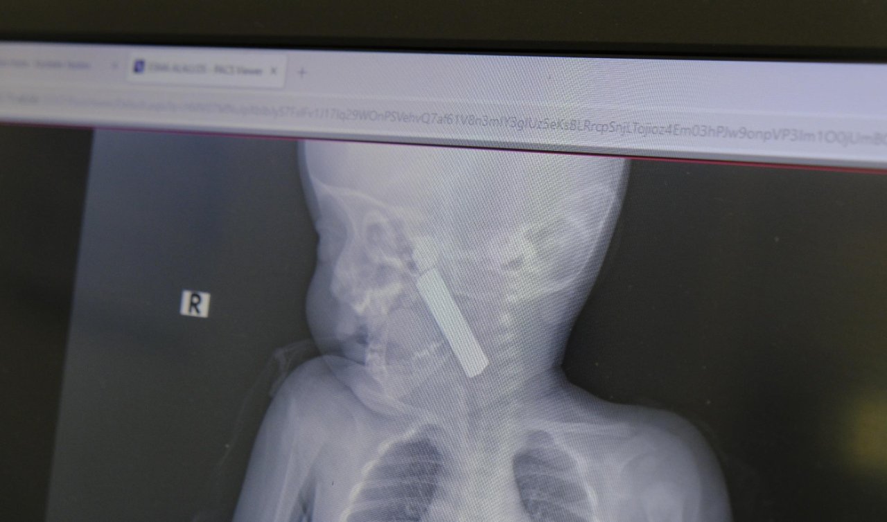 Boğazına kumanda pili kaçan bebek ölümden döndü