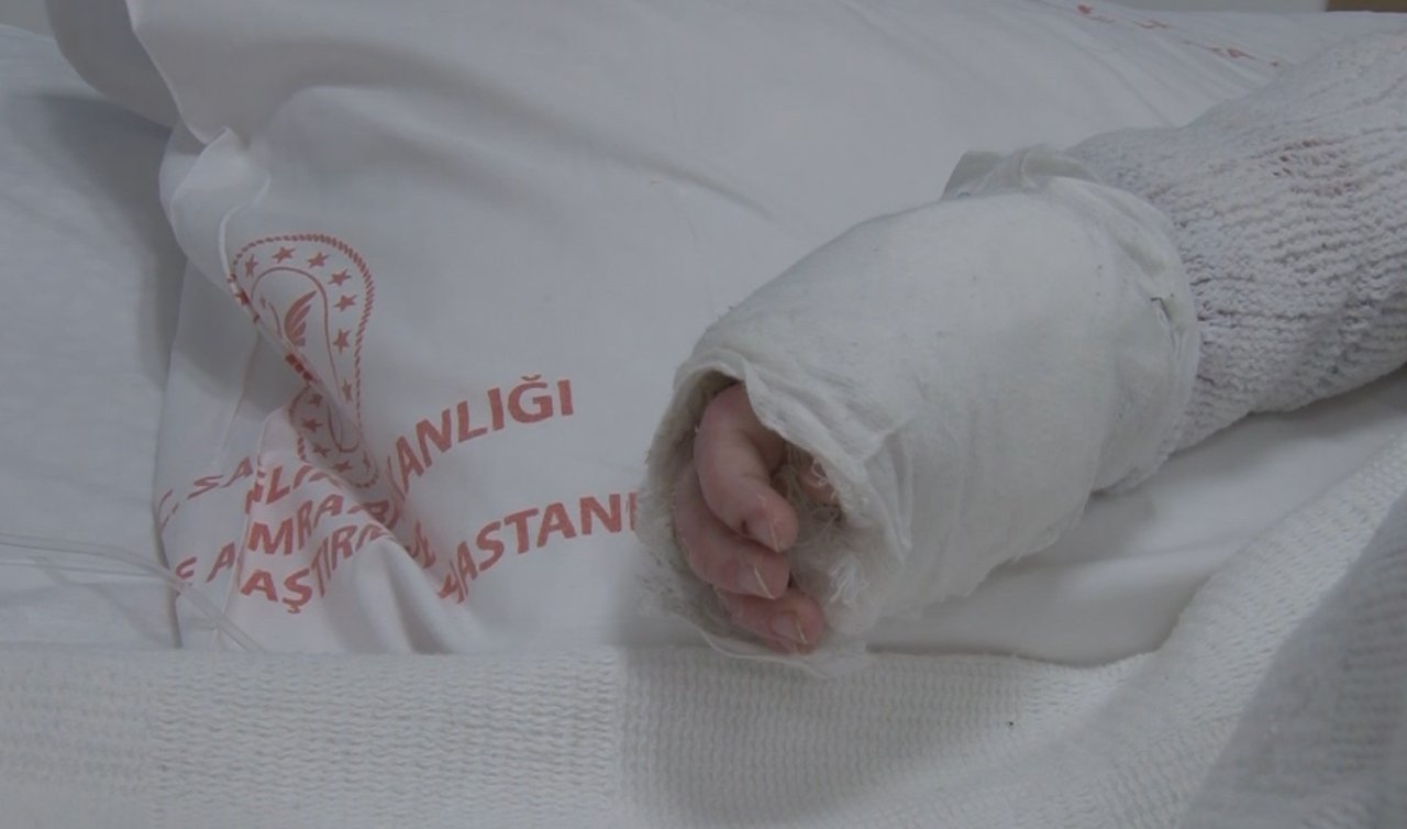 Üzerine kaynar su dökülen bebeğin vücudunun yüzde 27’si yandı