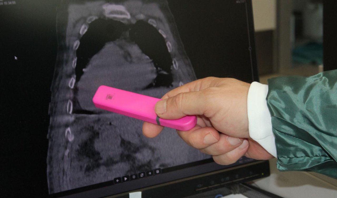 Giresun sendromu nedir? İsmini nerden aldı?