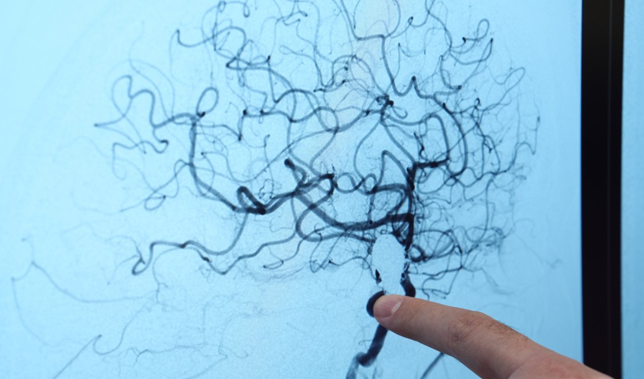 Beyin anevrizması her 20 kişiden birinde görülebilir