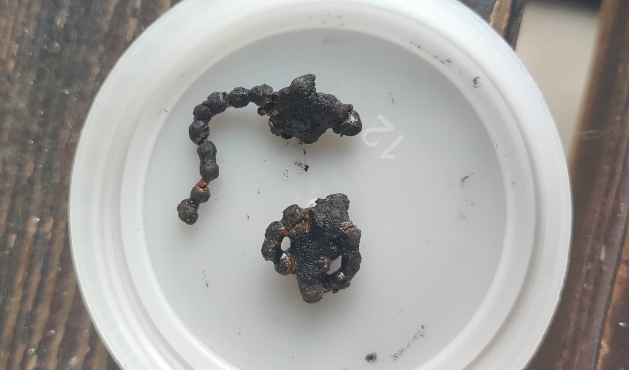 Burnundan zincir parçası çıkarılan çocuk sağlığına kavuştu