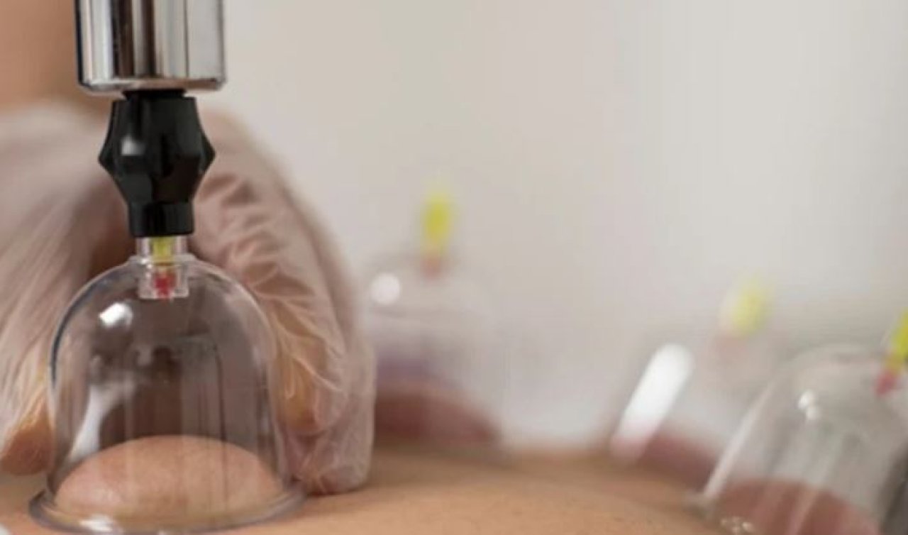 Nisan 2026 hacamat günleri: Sünnet olan hacamat tarihleri