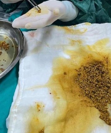 Hastanın ameliyatında 2 bin 67 taş çıkarıldı
