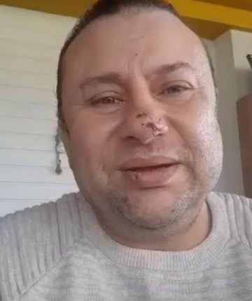 Pitbull saldırısına uğrayan ünlü sanatçı o anları anlattı: “Ben ölümden döndüm’’