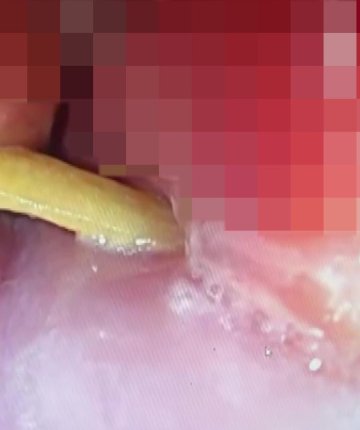 Boğazına saplanan 5 santimlik kemik öldürüyordu