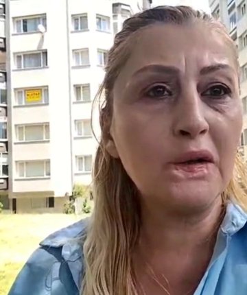 Estetik işlem sonrası dudağı çürüdü! 7 yıldır hukuk mücadelesi veriyor